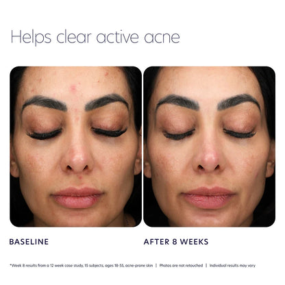 Acne Control Prebiotic Gel Cleanser